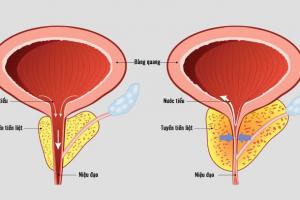 Dấu hiệu cảnh báo nam giới đang gặp vấn đề tuyến tiền liệt