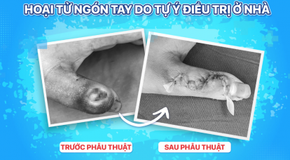Cháu bé 14 tuổi hoại tử ngón tay do tự ý đắp thuốc lá của thầy lang