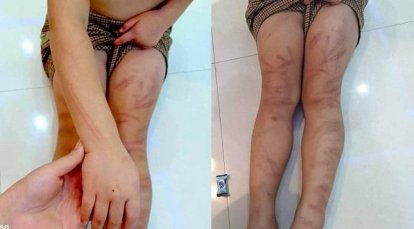 Bé gái mầm non 5 tuổi đánh 6 bạn cùng lớp bầm tím người